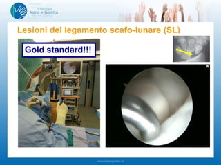 Lesioni del legamento scafo-lunare (SL)
Gold standard!!!
 