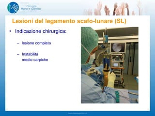 • Indicazione chirurgica:
– lesione completa
– Instabilità
medio carpiche
Lesioni del legamento scafo-lunare (SL)
 