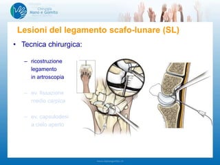 • Tecnica chirurgica:
– ricostruzione
legamento
in artroscopia
– ev. fissazione
medio carpica
– ev. capsulodesi
a cielo aperto
Lesioni del legamento scafo-lunare (SL)
 