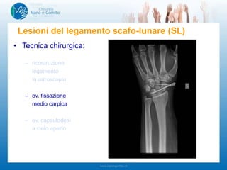 • Tecnica chirurgica:
– ricostruzione
legamento
in artroscopia
– ev. fissazione
medio carpica
– ev. capsulodesi
a cielo aperto
Lesioni del legamento scafo-lunare (SL)
 