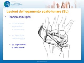 • Tecnica chirurgica:
– ricostruzione
legamento
in artroscopia
– ev. fissazione
medio carpica
– ev. capsulodesi
a cielo aperto
Lesioni del legamento scafo-lunare (SL)
 