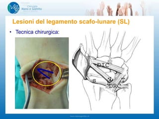• Tecnica chirurgica:
– ricostruzione
legamento
in artroscopia
– ev. fissazione
medio carpica
– ev. capsulodesi
a cielo aperto
Lesioni del legamento scafo-lunare (SL)
 