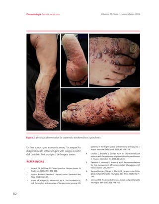 82
Dermatología Revista mexicana Volumen 58, Núm. 1, enero-febrero, 2014
En los casos que comunicamos, la sospecha
diagnóstica de infección por VIH surgió a partir
del cuadro clínico atípico de herpes zoster.
REFERENCIAS
1.	 Gnann JW, Whitley RJ. Clinical practice. Herpes zoster. N
Engl J Med 2002;347:340-346.
2.	 Alonzo Romero Pareyón L. Herpes zoster. Dermatol Rev
Mex 2011;55:24-39.
3.	 Gebo KA, Kalyani R, Moore RD, et al. The incidence of,
risk factors for, and sequelae of herpes zoster among HIV
patients in the highly active antiretroviral therapy era. J
Acquir Immune Defic Syndr 2005;40:169-174.
4.	 Chidiac C, Bruxelle J, Daures JP, et al. Characteristics of
patientswithherpeszosteronpresentationtopractitioners
in France. Clin Infect Dis 2001;33:62-69.
5.	 Dworkin R, Johnson R, Breuer J, et al. Recommendations
for the management of herpes zoster. Management of
herpes zoster CID 2007:44.
6.	 Sampathkumar P, Drage L, Martin D. Herpes zoster (shin-
gles) and postherpetic neuralgia. Clin Proc 2009;84:274-
280.
7.	 Johnson RW. Treatment of herpes zoster and postherpetic
neuralgia. BMJ 2003;326:748-750.
Figura 2. Vesículas diseminadas de contenido serohemático y purulento.
 
