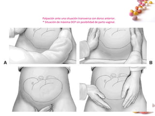 #
2. : DCP:
Dimensiones fetales en la
DCP
Palpación ante una situación transversa con dorso anterior.
* Situación de máxima DCP sin posibilidad de parto vaginal.
 