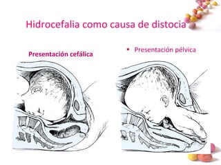 #
Hidrocefalia como causa de distocia
Presentación cefálica
• Presentación pélvica
 