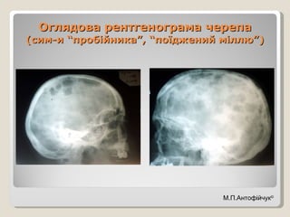 Оглядова рентгенограма черепа (сим-и “пробійника”, “поїджений міллю”) М.П.Антофійчук © 