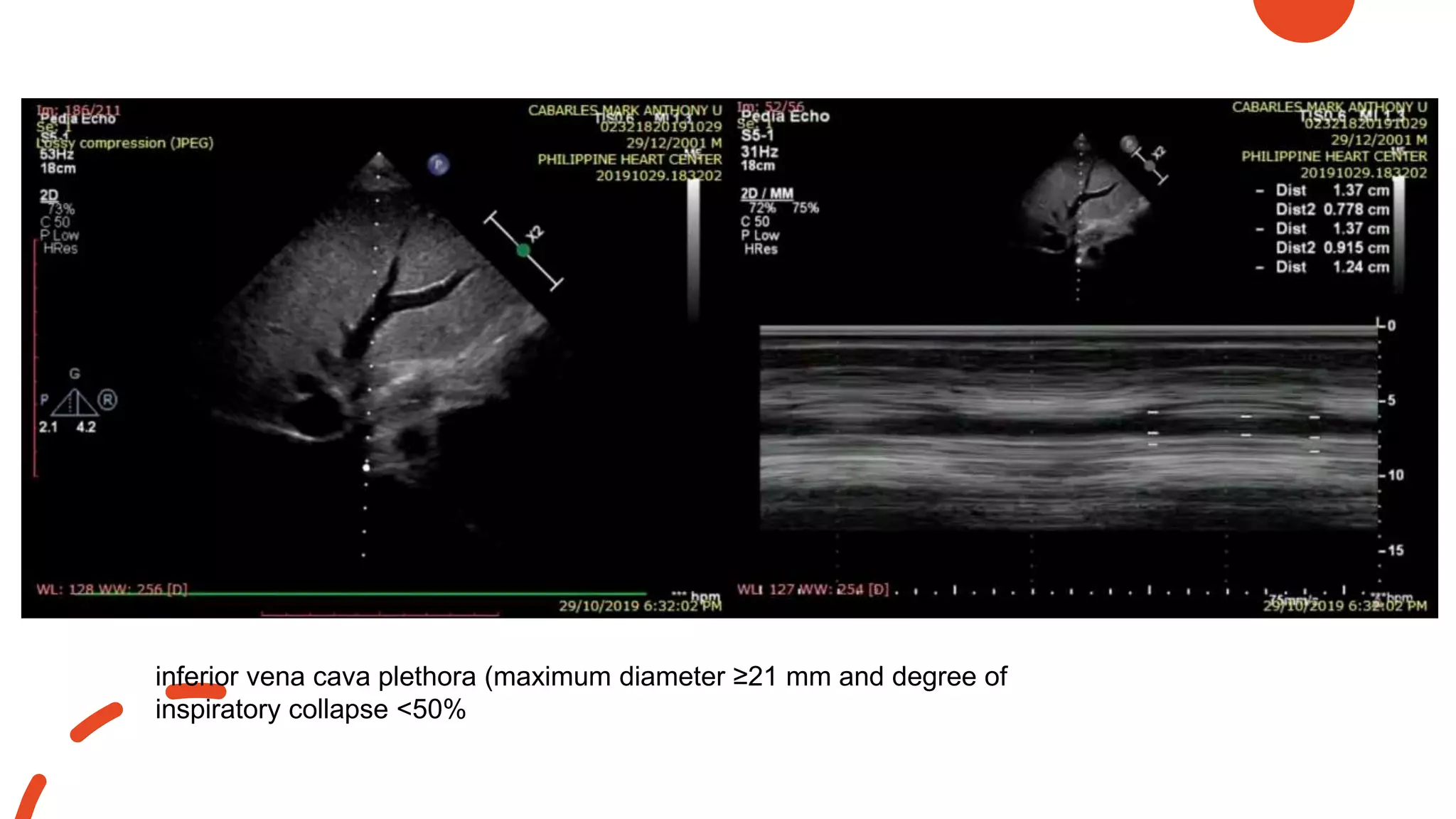 inferior vena cava plethora (maximum diameter ≥21 mm and degree of
inspiratory collapse <50%
 