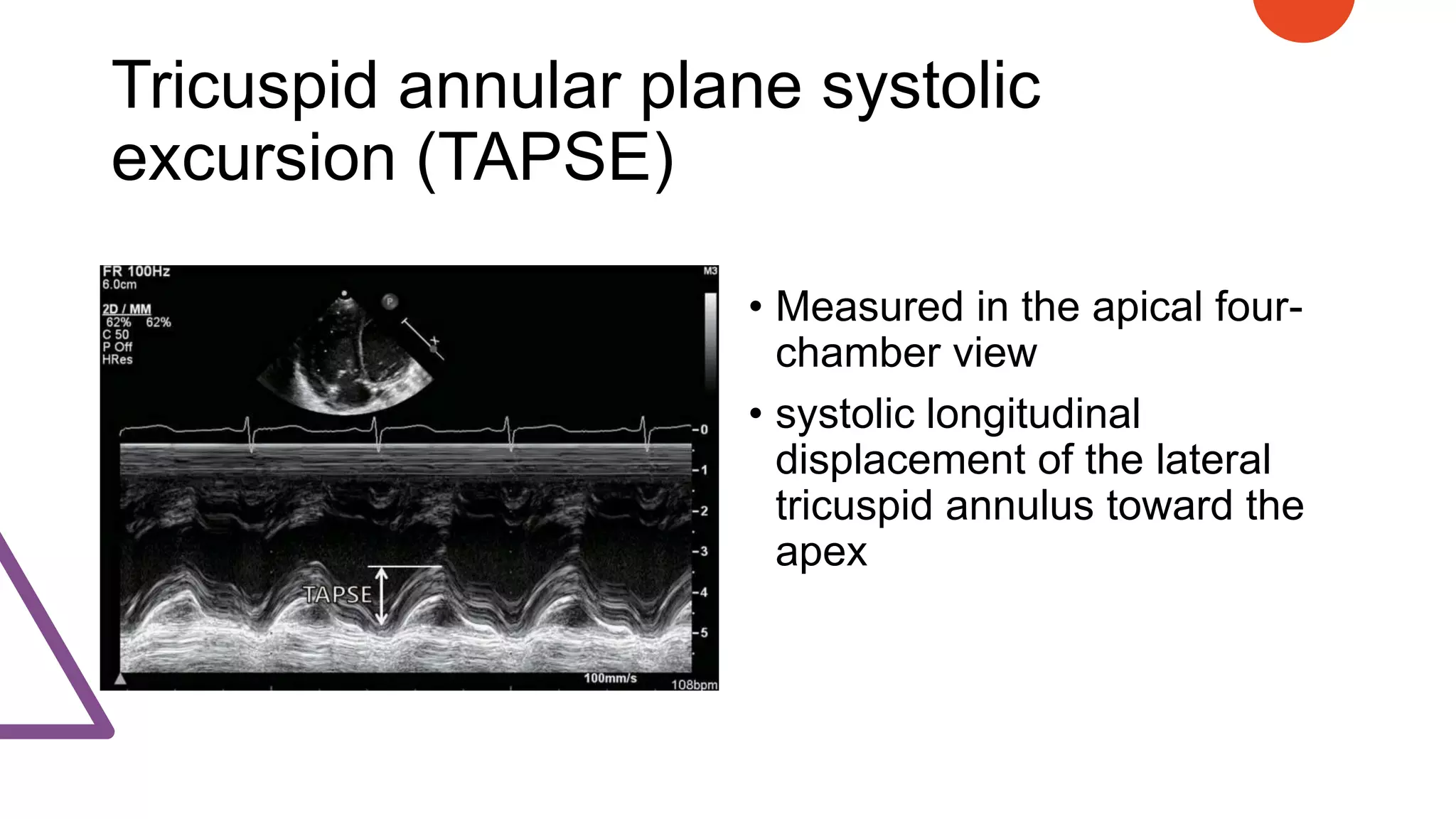 Tricuspid annular plane systolic
excursion (TAPSE)
• Measured in the apical four-
chamber view
• systolic longitudinal
displacement of the lateral
tricuspid annulus toward the
apex
 