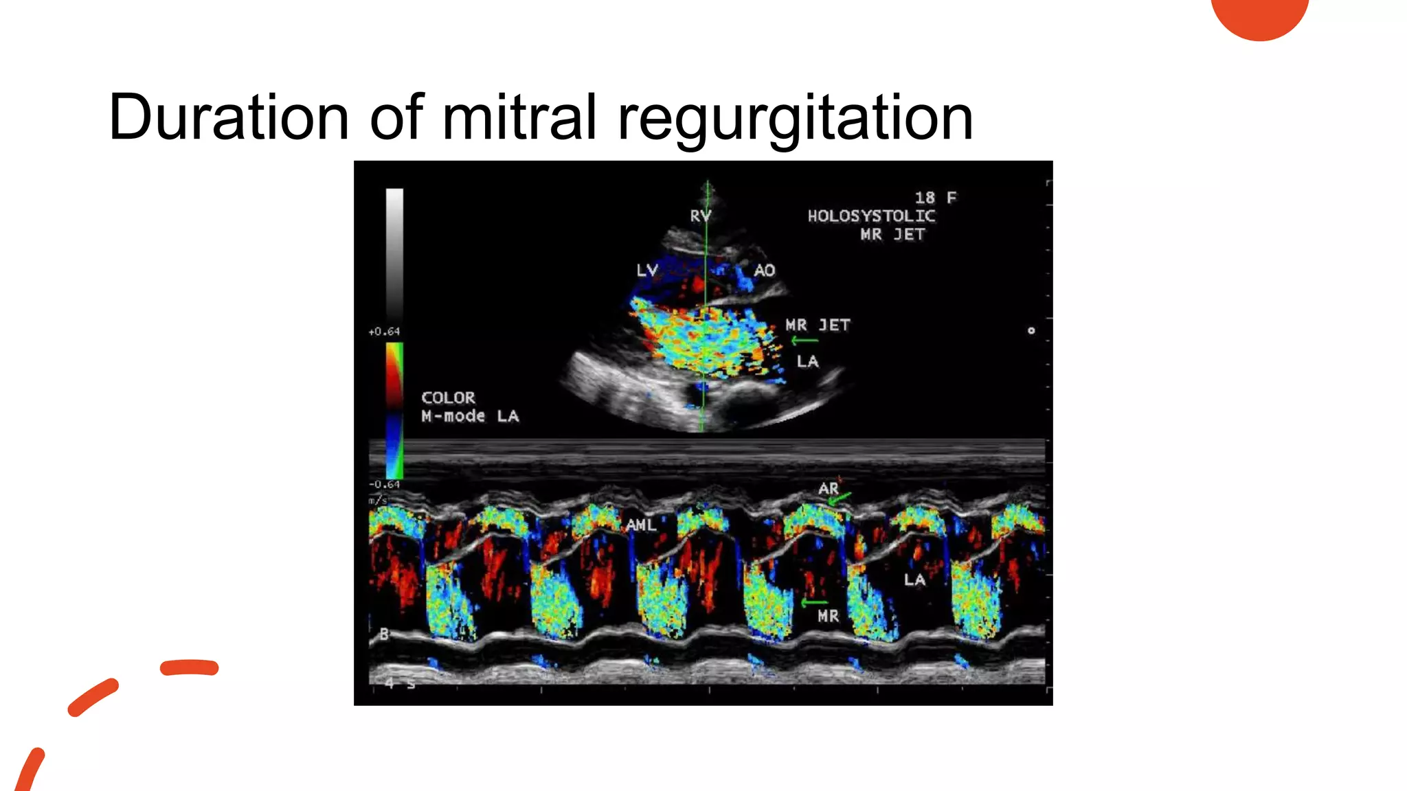 Duration of mitral regurgitation
 