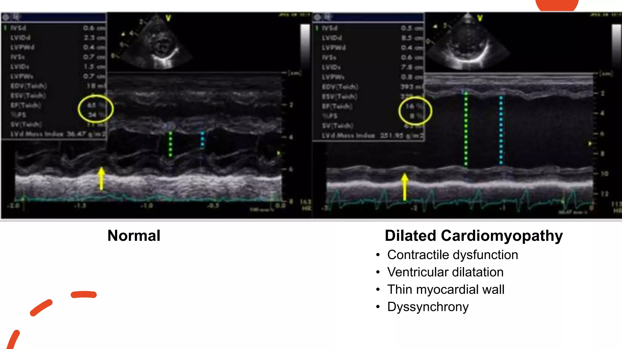 • Contractile dysfunction
• Ventricular dilatation
• Thin myocardial wall
• Dyssynchrony
Normal Dilated Cardiomyopathy
 