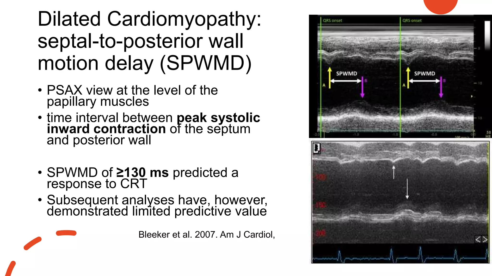 Dilated Cardiomyopathy:
septal-to-posterior wall
motion delay (SPWMD)
• PSAX view at the level of the
papillary muscles
• time interval between peak systolic
inward contraction of the septum
and posterior wall
• SPWMD of ≥130 ms predicted a
response to CRT
• Subsequent analyses have, however,
demonstrated limited predictive value
Bleeker et al. 2007. Am J Cardiol,
 