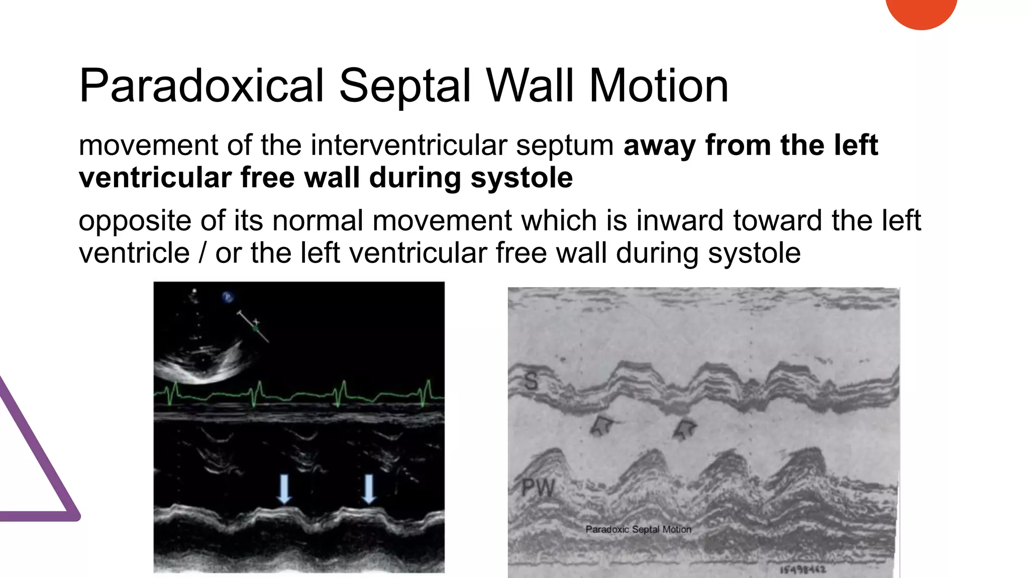 Paradoxical Septal Wall Motion
movement of the interventricular septum away from the left
ventricular free wall during systole
opposite of its normal movement which is inward toward the left
ventricle / or the left ventricular free wall during systole
 