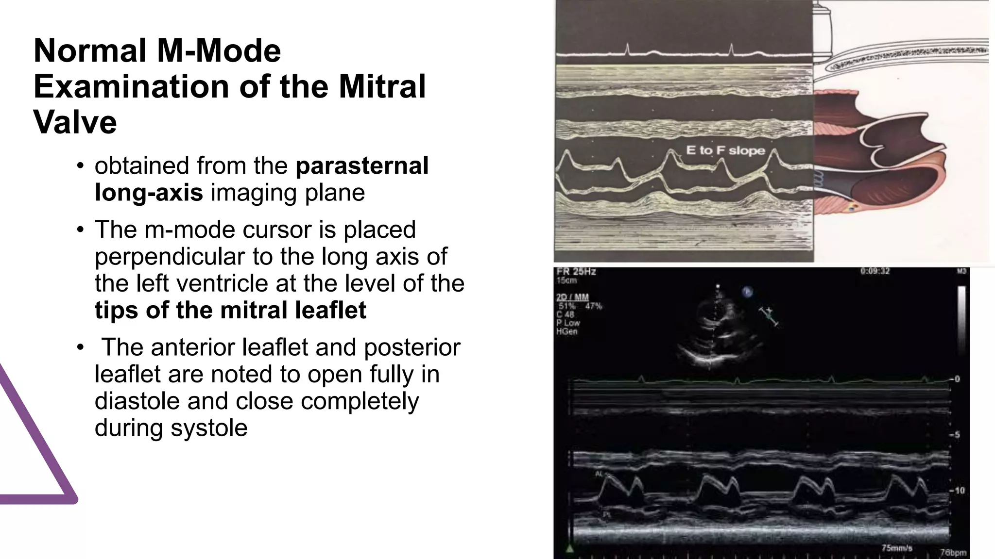 Normal M-Mode
Examination of the Mitral
Valve
• obtained from the parasternal
long-axis imaging plane
• The m-mode cursor is placed
perpendicular to the long axis of
the left ventricle at the level of the
tips of the mitral leaflet
• The anterior leaflet and posterior
leaflet are noted to open fully in
diastole and close completely
during systole
 