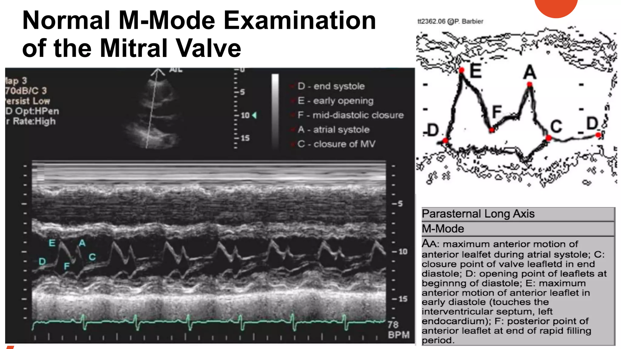 Normal M-Mode Examination
of the Mitral Valve
 