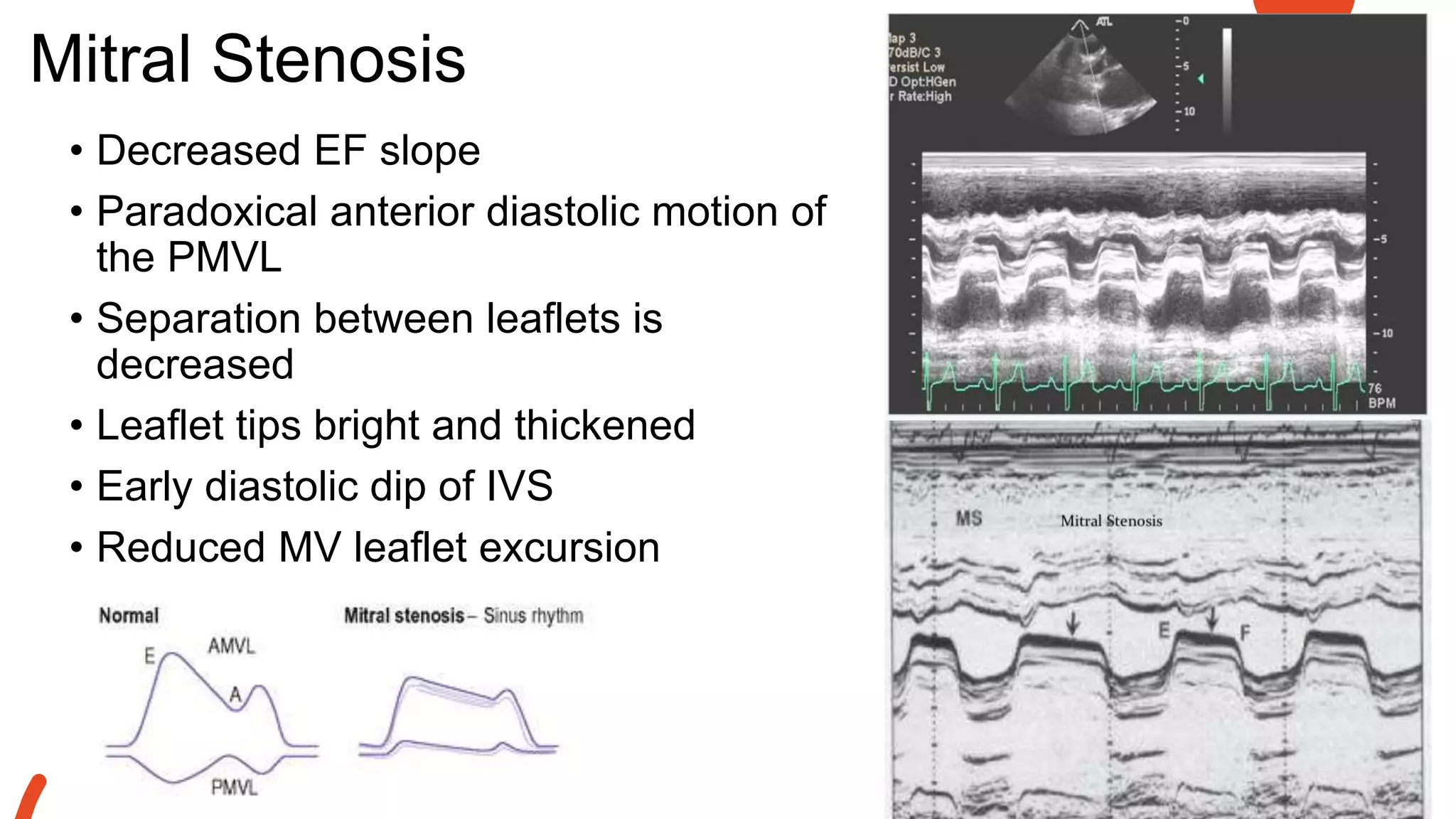 Mitral Stenosis
• Decreased EF slope
• Paradoxical anterior diastolic motion of
the PMVL
• Separation between leaflets is
decreased
• Leaflet tips bright and thickened
• Early diastolic dip of IVS
• Reduced MV leaflet excursion
 