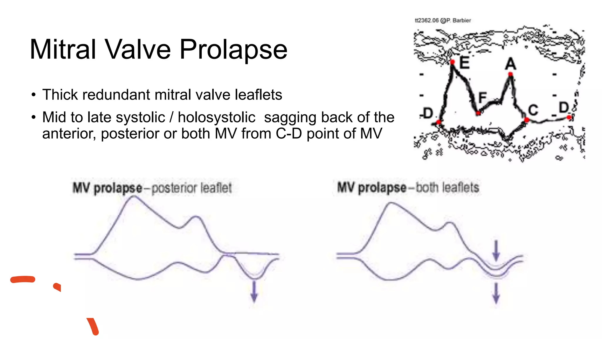 Mitral Valve Prolapse
• Thick redundant mitral valve leaflets
• Mid to late systolic / holosystolic sagging back of the
anterior, posterior or both MV from C-D point of MV
 