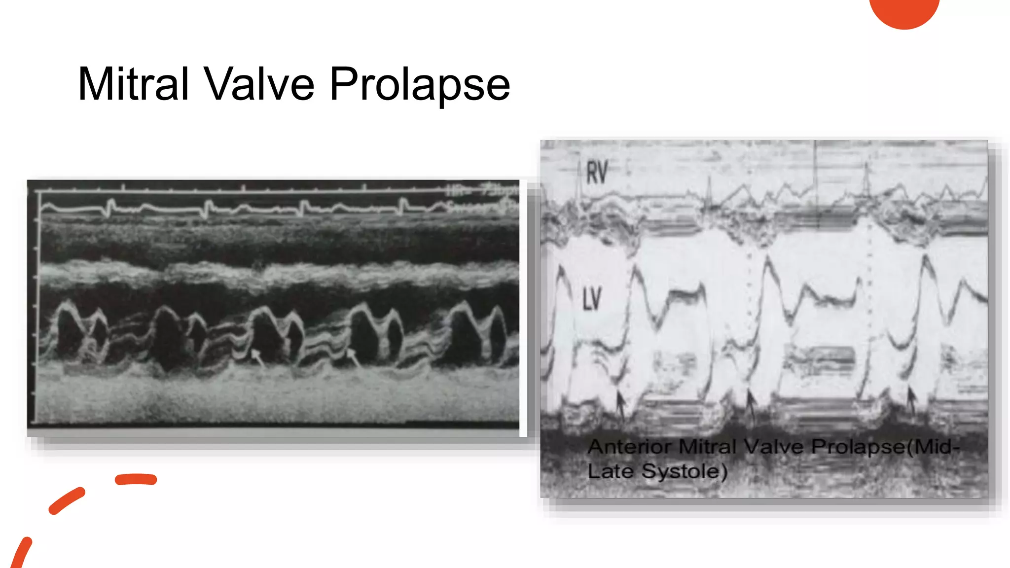 Mitral Valve Prolapse
 