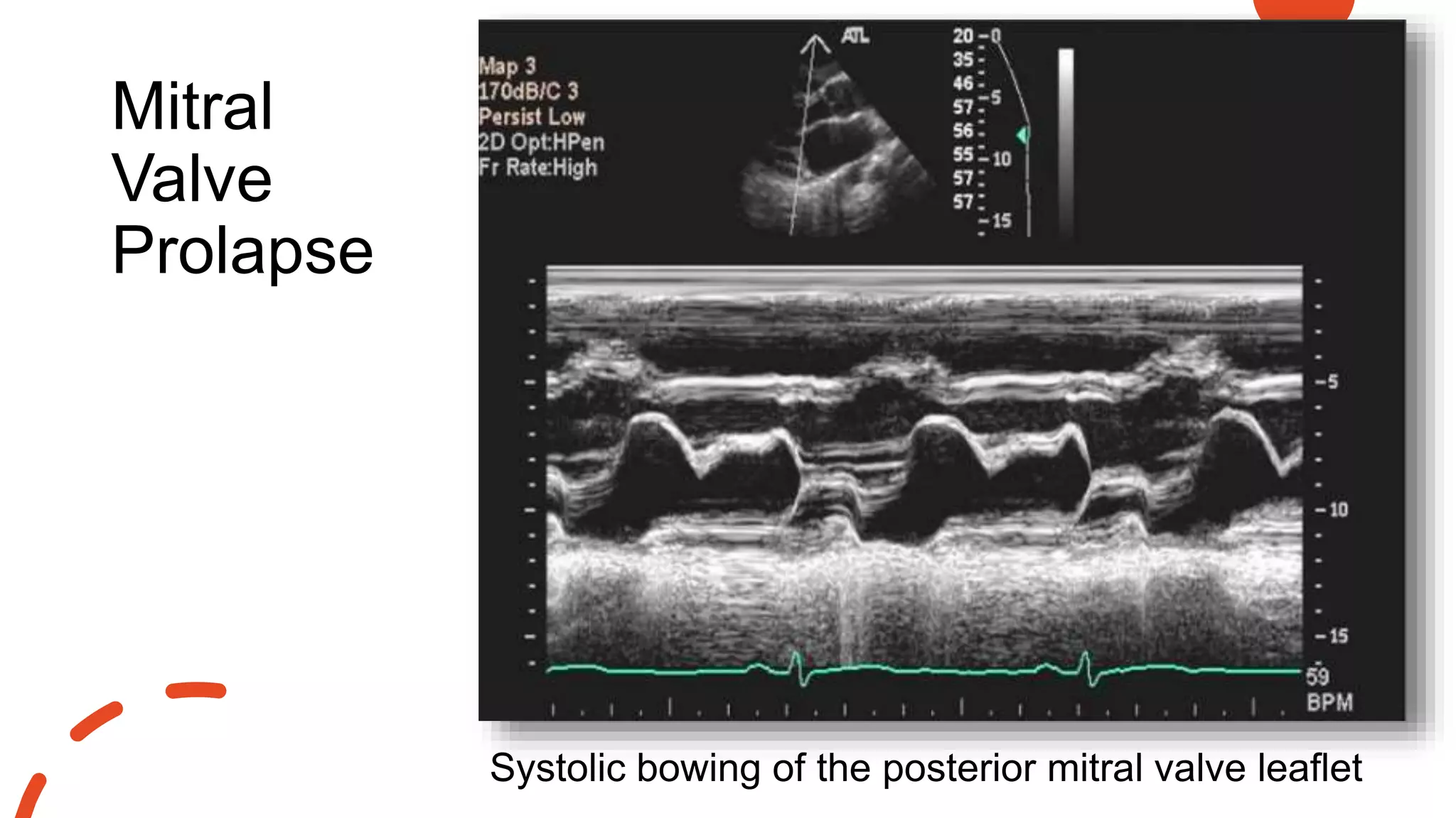 Mitral
Valve
Prolapse
Systolic bowing of the posterior mitral valve leaflet
 