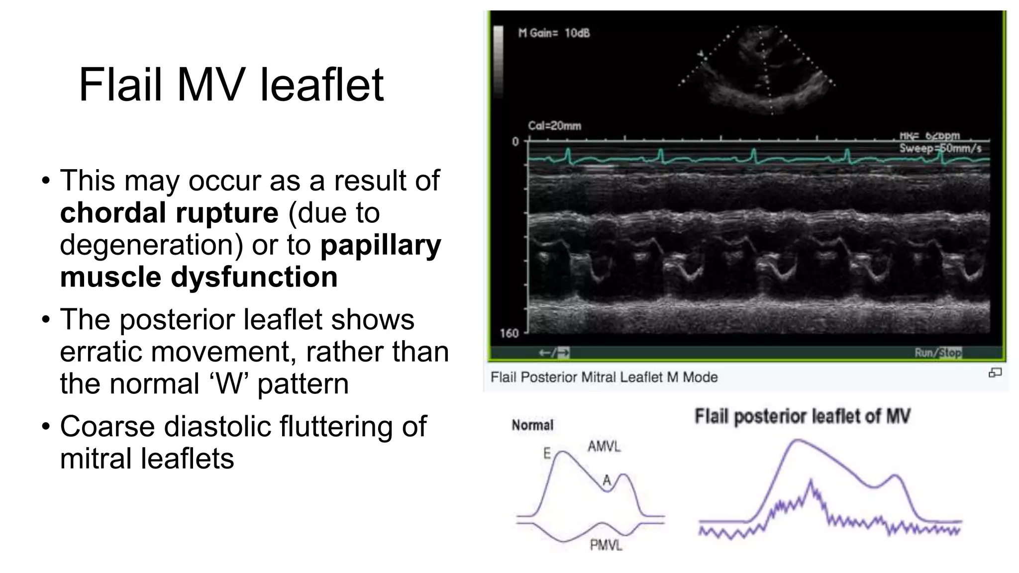 Flail MV leaflet
• This may occur as a result of
chordal rupture (due to
degeneration) or to papillary
muscle dysfunction
• The posterior leaflet shows
erratic movement, rather than
the normal ‘W’ pattern
• Coarse diastolic fluttering of
mitral leaflets
 