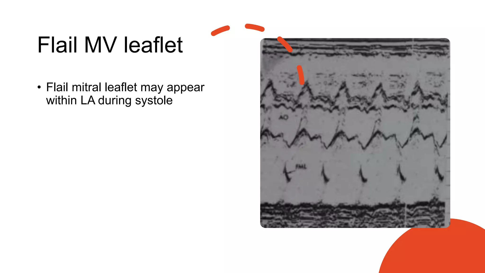 Flail MV leaflet
• Flail mitral leaflet may appear
within LA during systole
 