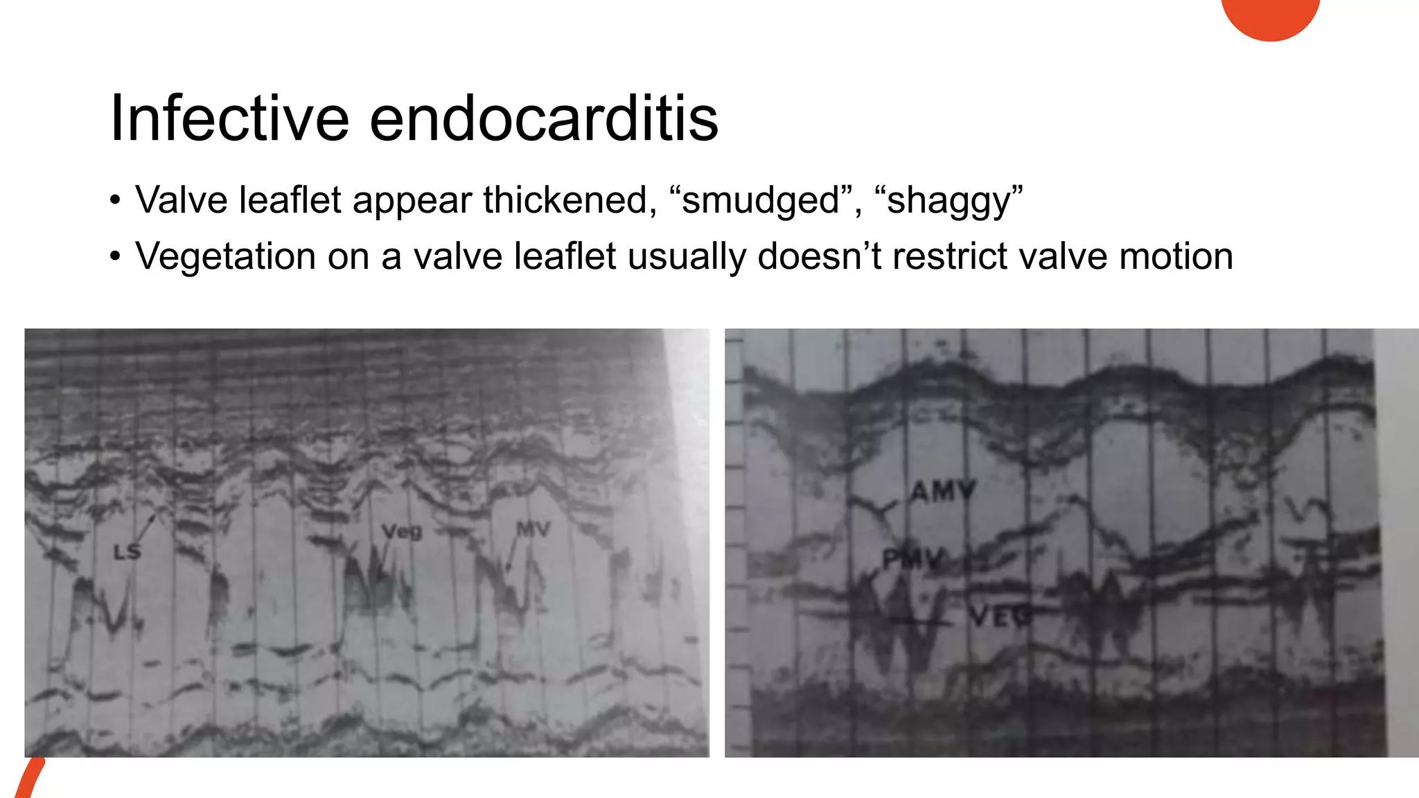 Infective endocarditis
• Valve leaflet appear thickened, “smudged”, “shaggy”
• Vegetation on a valve leaflet usually doesn’t restrict valve motion
 