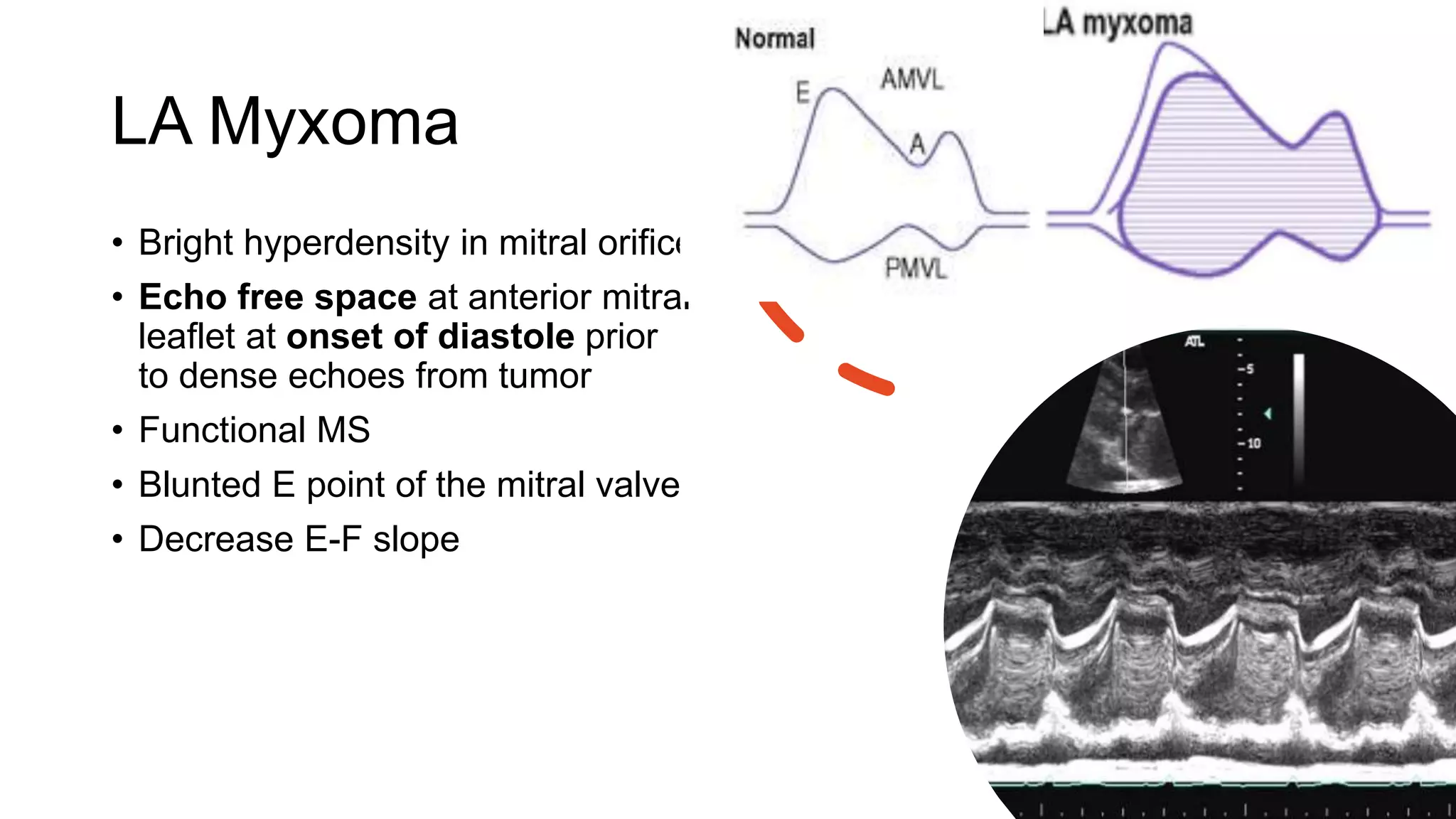 LA Myxoma
• Bright hyperdensity in mitral orifice
• Echo free space at anterior mitral
leaflet at onset of diastole prior
to dense echoes from tumor
• Functional MS
• Blunted E point of the mitral valve
• Decrease E-F slope
 