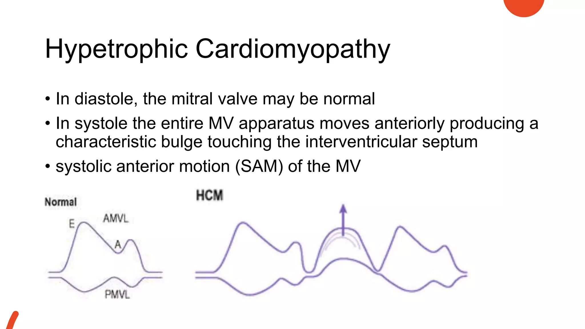 Hypetrophic Cardiomyopathy
• In diastole, the mitral valve may be normal
• In systole the entire MV apparatus moves anteriorly producing a
characteristic bulge touching the interventricular septum
• systolic anterior motion (SAM) of the MV
 