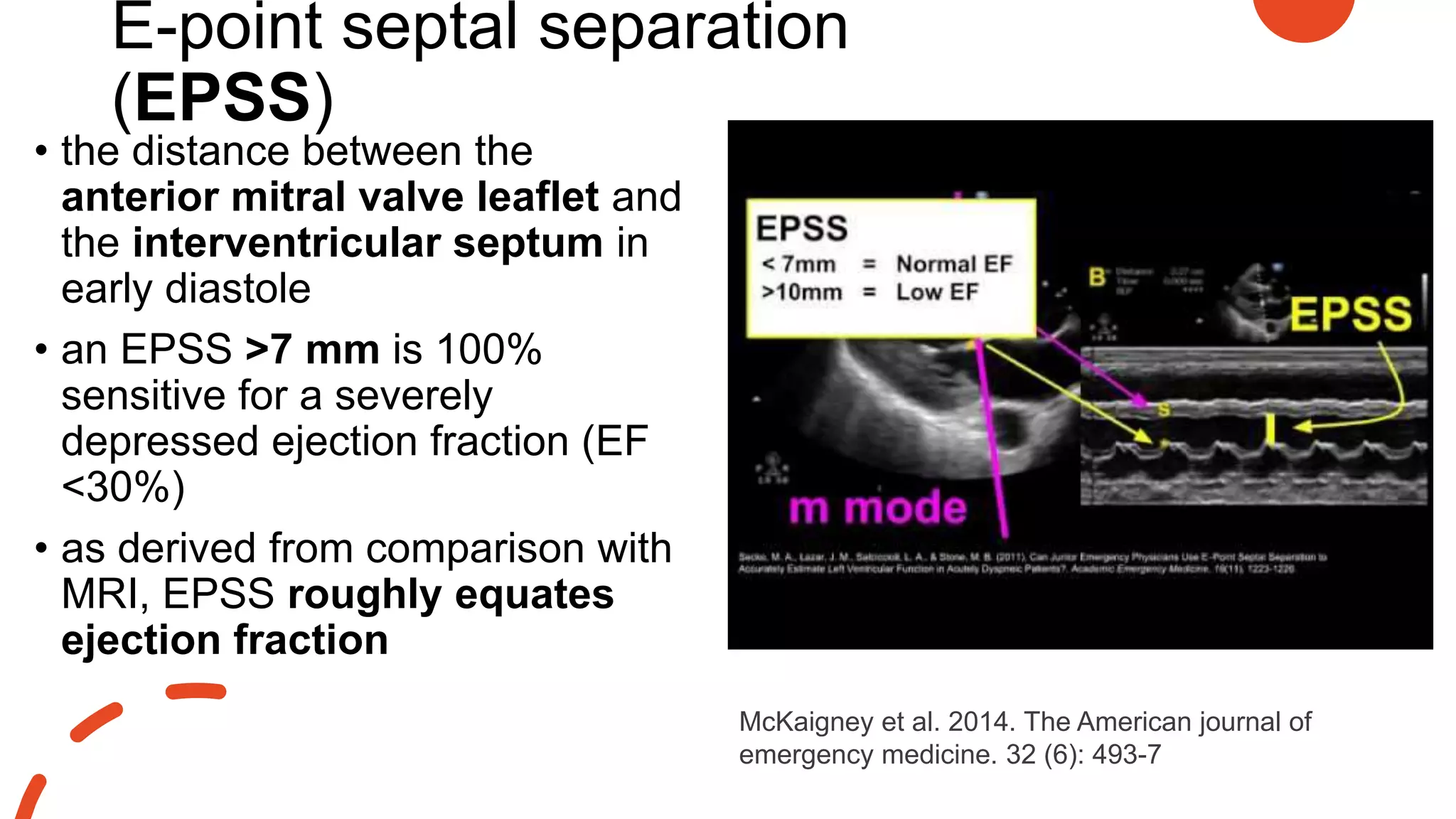 E-point septal separation
(EPSS)
• the distance between the
anterior mitral valve leaflet and
the interventricular septum in
early diastole
• an EPSS >7 mm is 100%
sensitive for a severely
depressed ejection fraction (EF
<30%)
• as derived from comparison with
MRI, EPSS roughly equates
ejection fraction
McKaigney et al. 2014. The American journal of
emergency medicine. 32 (6): 493-7
 