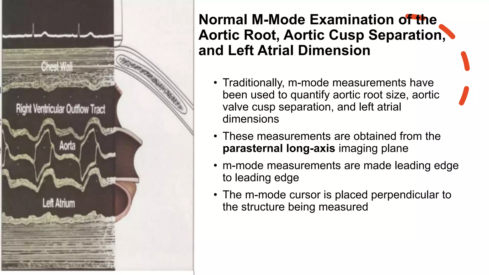 Normal M-Mode Examination of the
Aortic Root, Aortic Cusp Separation,
and Left Atrial Dimension
• Traditionally, m-mode measurements have
been used to quantify aortic root size, aortic
valve cusp separation, and left atrial
dimensions
• These measurements are obtained from the
parasternal long-axis imaging plane
• m-mode measurements are made leading edge
to leading edge
• The m-mode cursor is placed perpendicular to
the structure being measured
 