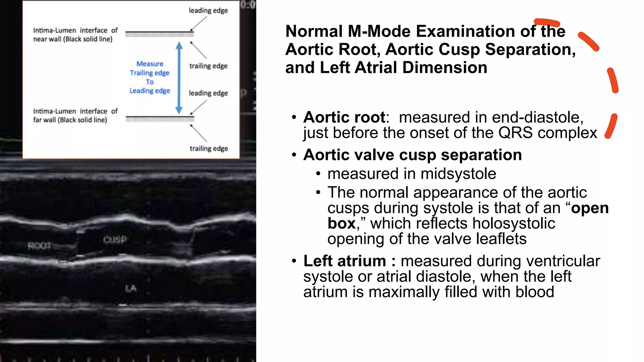 Normal M-Mode Examination of the
Aortic Root, Aortic Cusp Separation,
and Left Atrial Dimension
• Aortic root: measured in end-diastole,
just before the onset of the QRS complex
• Aortic valve cusp separation
• measured in midsystole
• The normal appearance of the aortic
cusps during systole is that of an “open
box,” which reflects holosystolic
opening of the valve leaflets
• Left atrium : measured during ventricular
systole or atrial diastole, when the left
atrium is maximally filled with blood
 