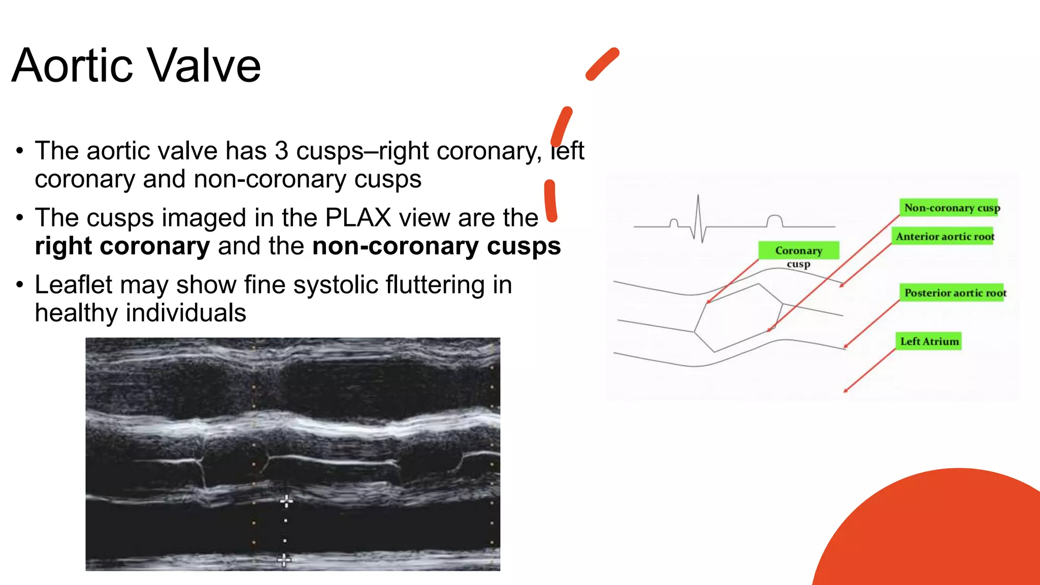 Aortic Valve
• The aortic valve has 3 cusps–right coronary, left
coronary and non-coronary cusps
• The cusps imaged in the PLAX view are the
right coronary and the non-coronary cusps
• Leaflet may show fine systolic fluttering in
healthy individuals
 