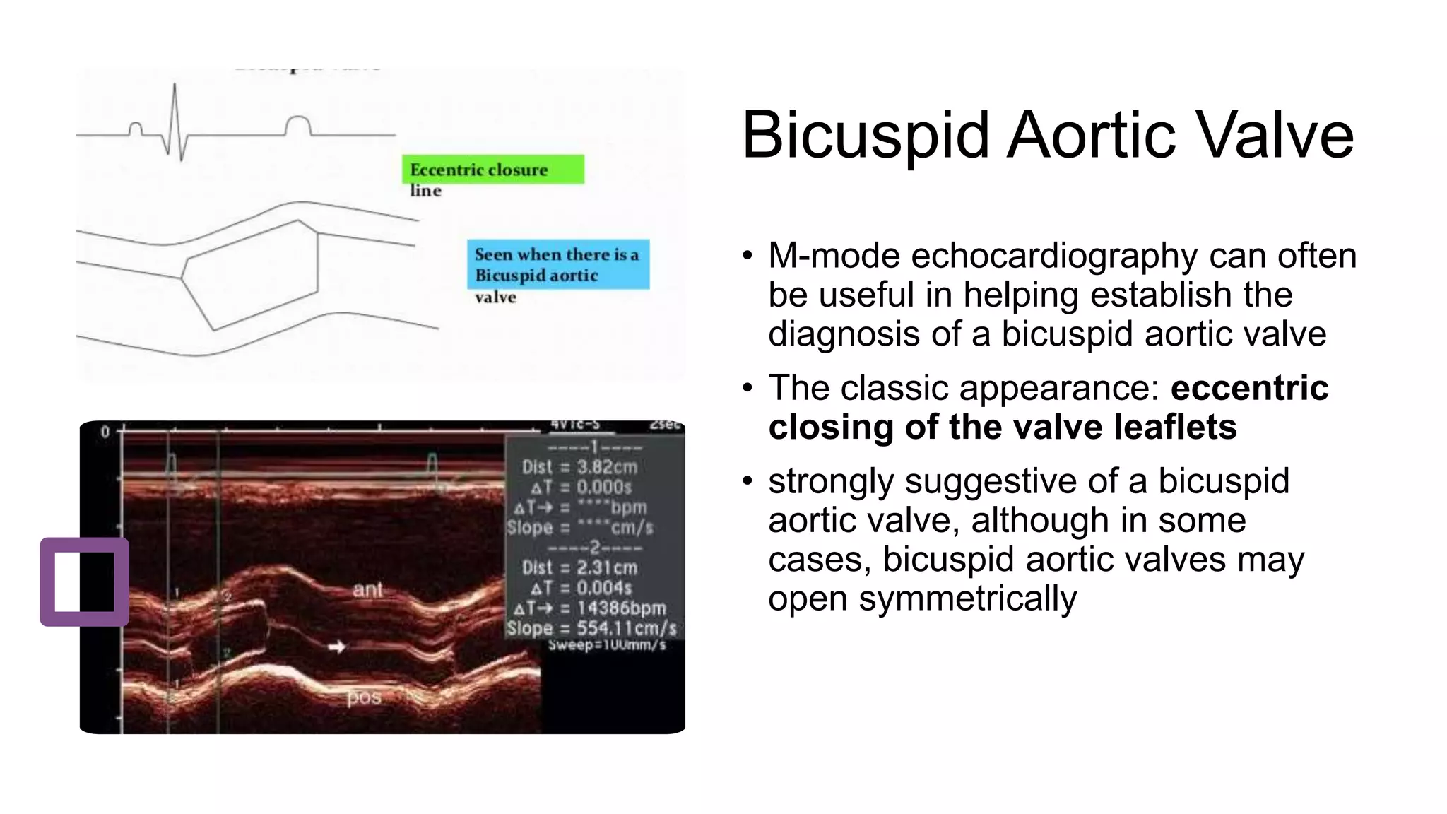 Bicuspid Aortic Valve
• M-mode echocardiography can often
be useful in helping establish the
diagnosis of a bicuspid aortic valve
• The classic appearance: eccentric
closing of the valve leaflets
• strongly suggestive of a bicuspid
aortic valve, although in some
cases, bicuspid aortic valves may
open symmetrically
 
