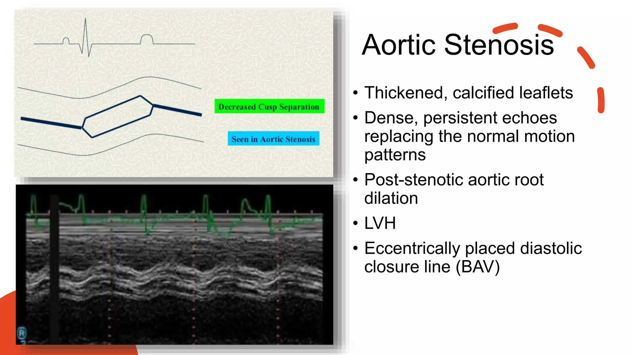 Aortic Stenosis
• Thickened, calcified leaflets
• Dense, persistent echoes
replacing the normal motion
patterns
• Post-stenotic aortic root
dilation
• LVH
• Eccentrically placed diastolic
closure line (BAV)
 