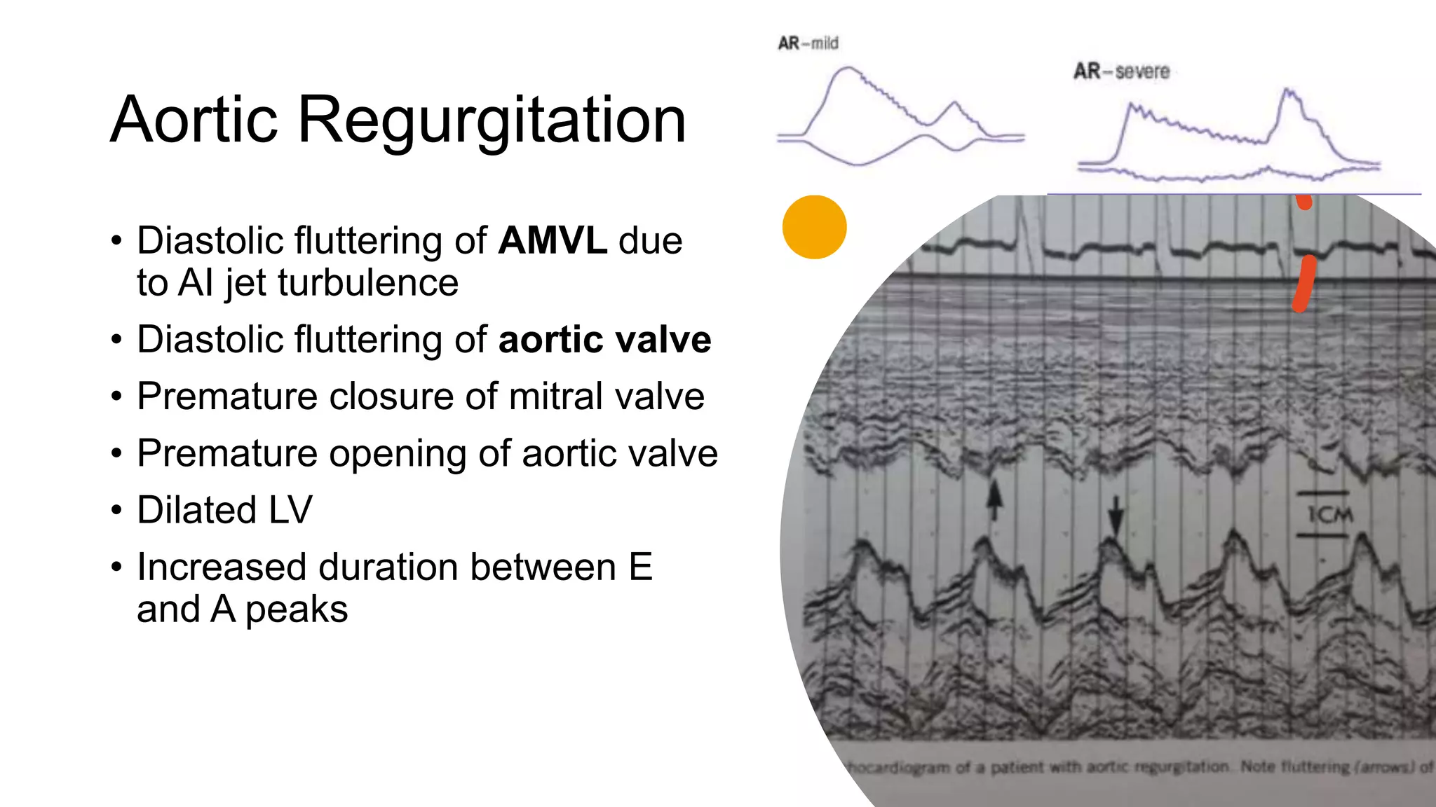 Aortic Regurgitation
• Diastolic fluttering of AMVL due
to AI jet turbulence
• Diastolic fluttering of aortic valve
• Premature closure of mitral valve
• Premature opening of aortic valve
• Dilated LV
• Increased duration between E
and A peaks
 