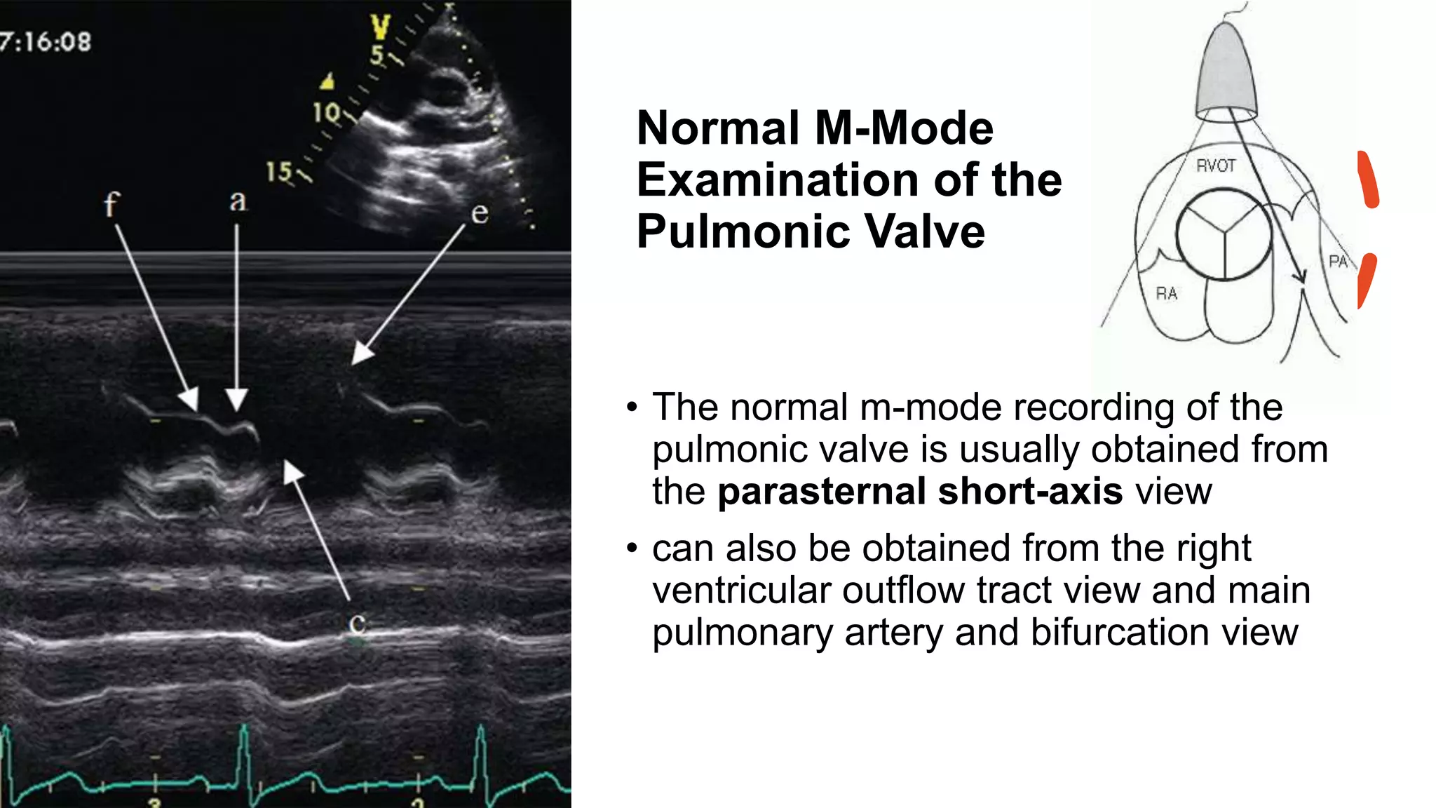 Normal M-Mode
Examination of the
Pulmonic Valve
• The normal m-mode recording of the
pulmonic valve is usually obtained from
the parasternal short-axis view
• can also be obtained from the right
ventricular outflow tract view and main
pulmonary artery and bifurcation view
 