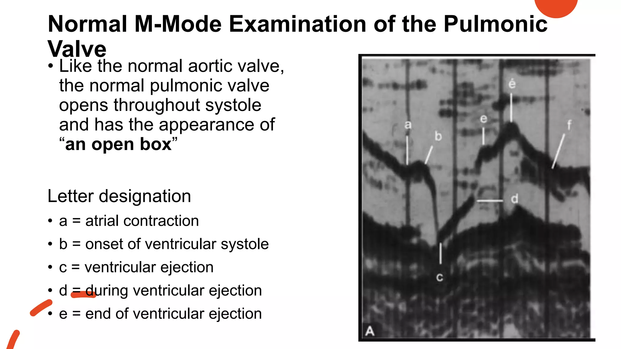 Normal M-Mode Examination of the Pulmonic
Valve
• Like the normal aortic valve,
the normal pulmonic valve
opens throughout systole
and has the appearance of
“an open box”
Letter designation
• a = atrial contraction
• b = onset of ventricular systole
• c = ventricular ejection
• d = during ventricular ejection
• e = end of ventricular ejection
 