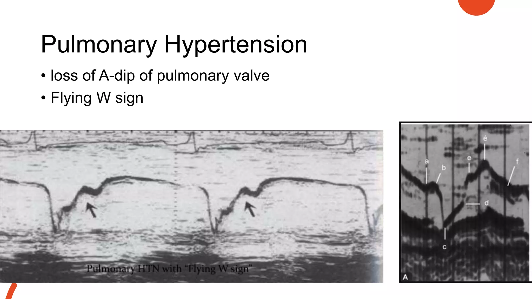 Pulmonary Hypertension
• loss of A-dip of pulmonary valve
• Flying W sign
 
