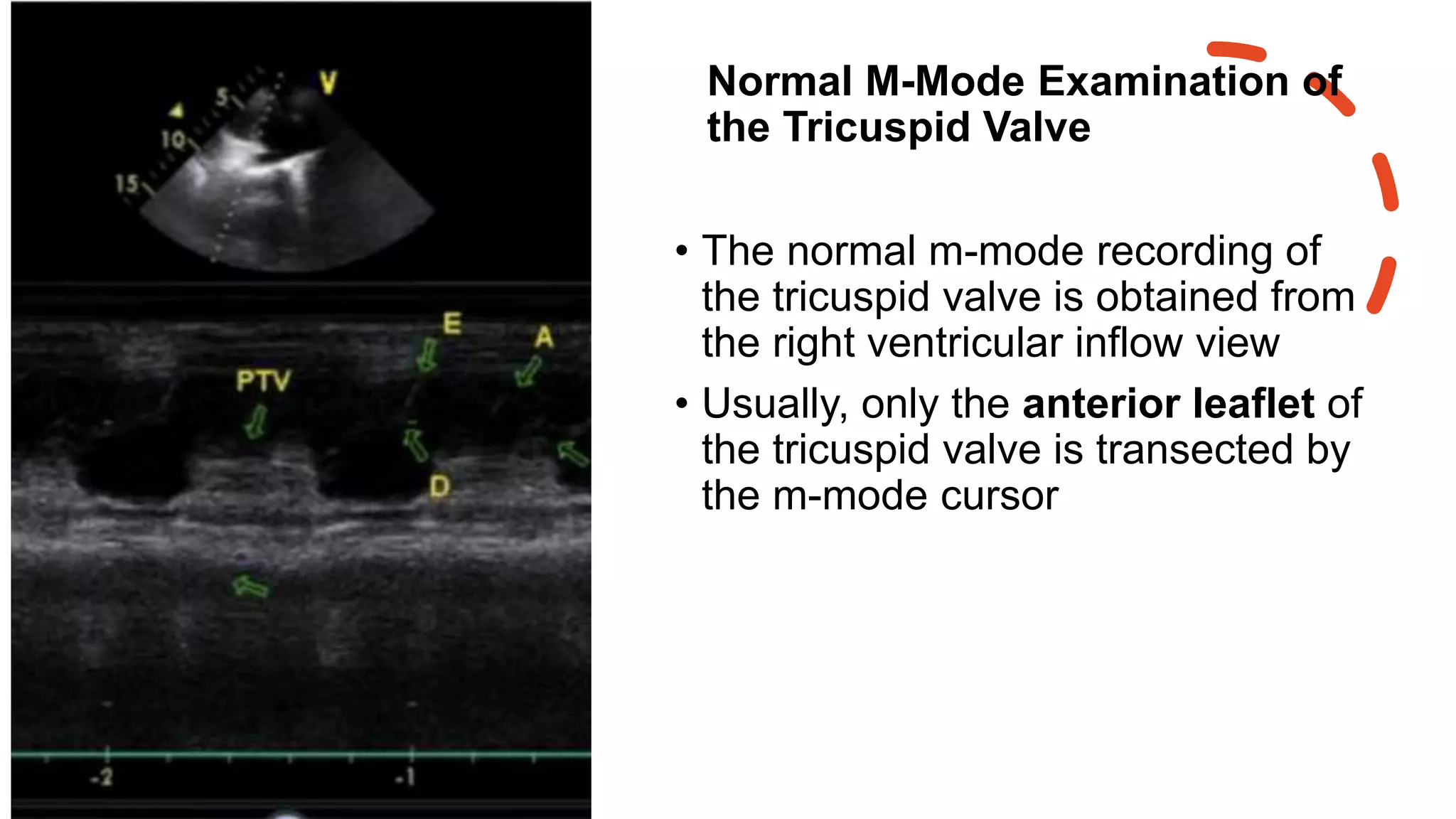 Normal M-Mode Examination of
the Tricuspid Valve
• The normal m-mode recording of
the tricuspid valve is obtained from
the right ventricular inflow view
• Usually, only the anterior leaflet of
the tricuspid valve is transected by
the m-mode cursor
 