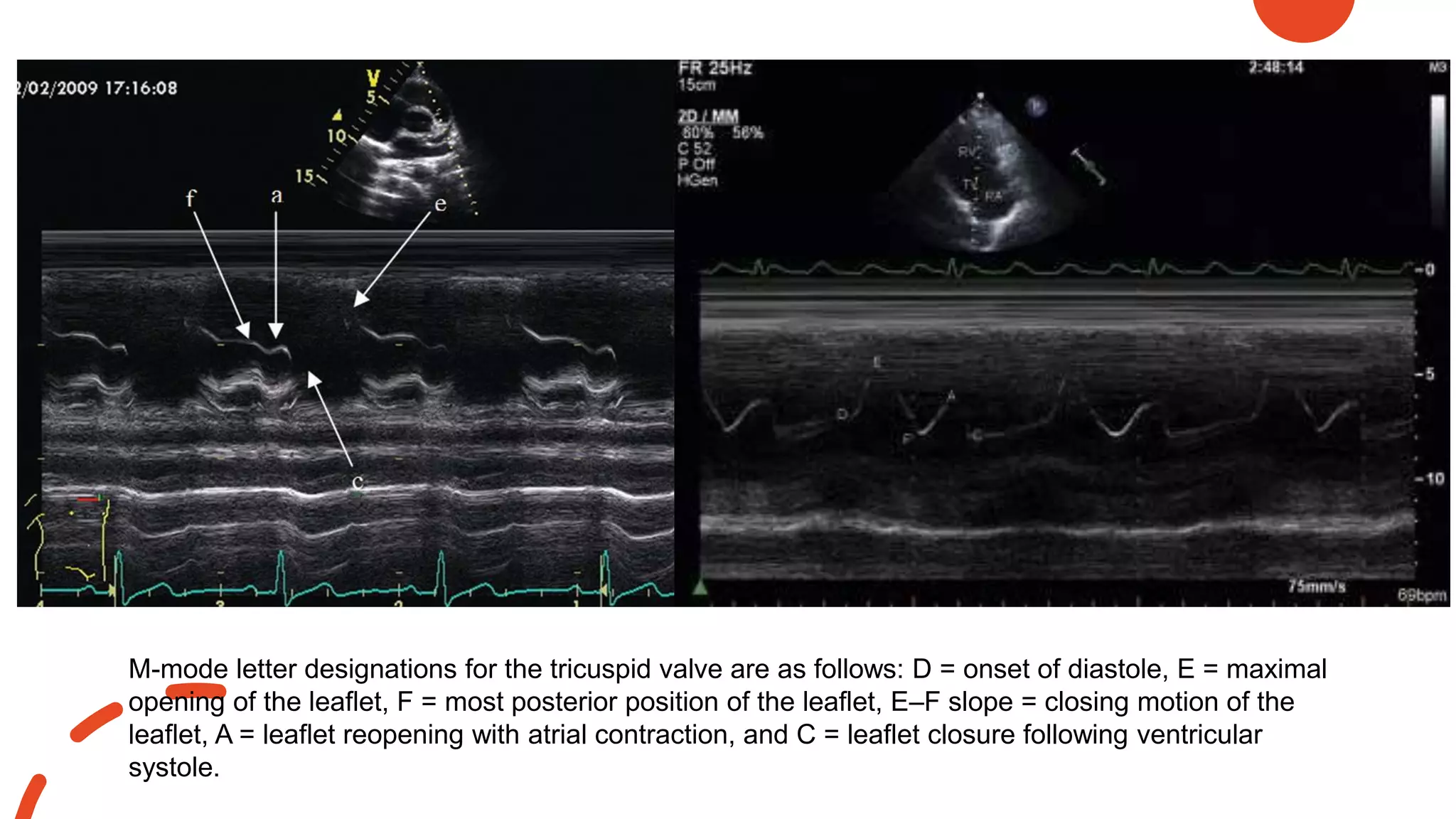 M-mode letter designations for the tricuspid valve are as follows: D = onset of diastole, E = maximal
opening of the leaflet, F = most posterior position of the leaflet, E–F slope = closing motion of the
leaflet, A = leaflet reopening with atrial contraction, and C = leaflet closure following ventricular
systole.
 