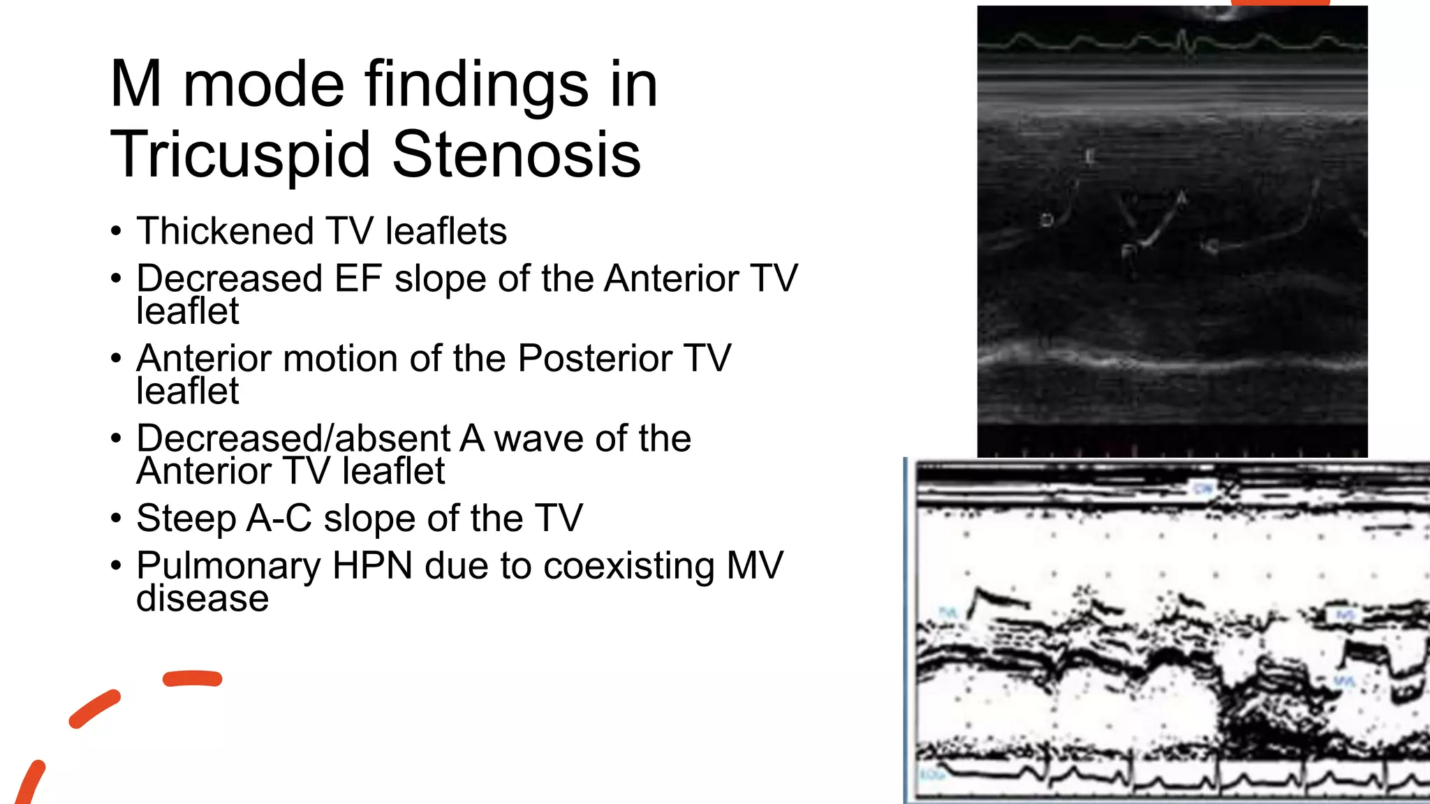 M mode findings in
Tricuspid Stenosis
• Thickened TV leaflets
• Decreased EF slope of the Anterior TV
leaflet
• Anterior motion of the Posterior TV
leaflet
• Decreased/absent A wave of the
Anterior TV leaflet
• Steep A-C slope of the TV
• Pulmonary HPN due to coexisting MV
disease
 