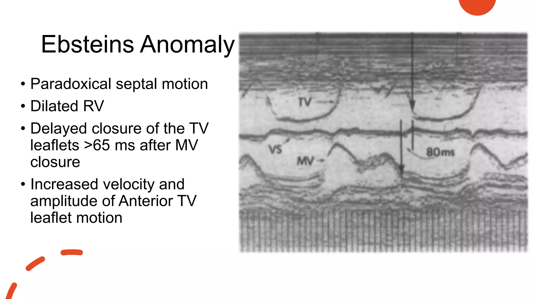 Ebsteins Anomaly
• Paradoxical septal motion
• Dilated RV
• Delayed closure of the TV
leaflets >65 ms after MV
closure
• Increased velocity and
amplitude of Anterior TV
leaflet motion
 
