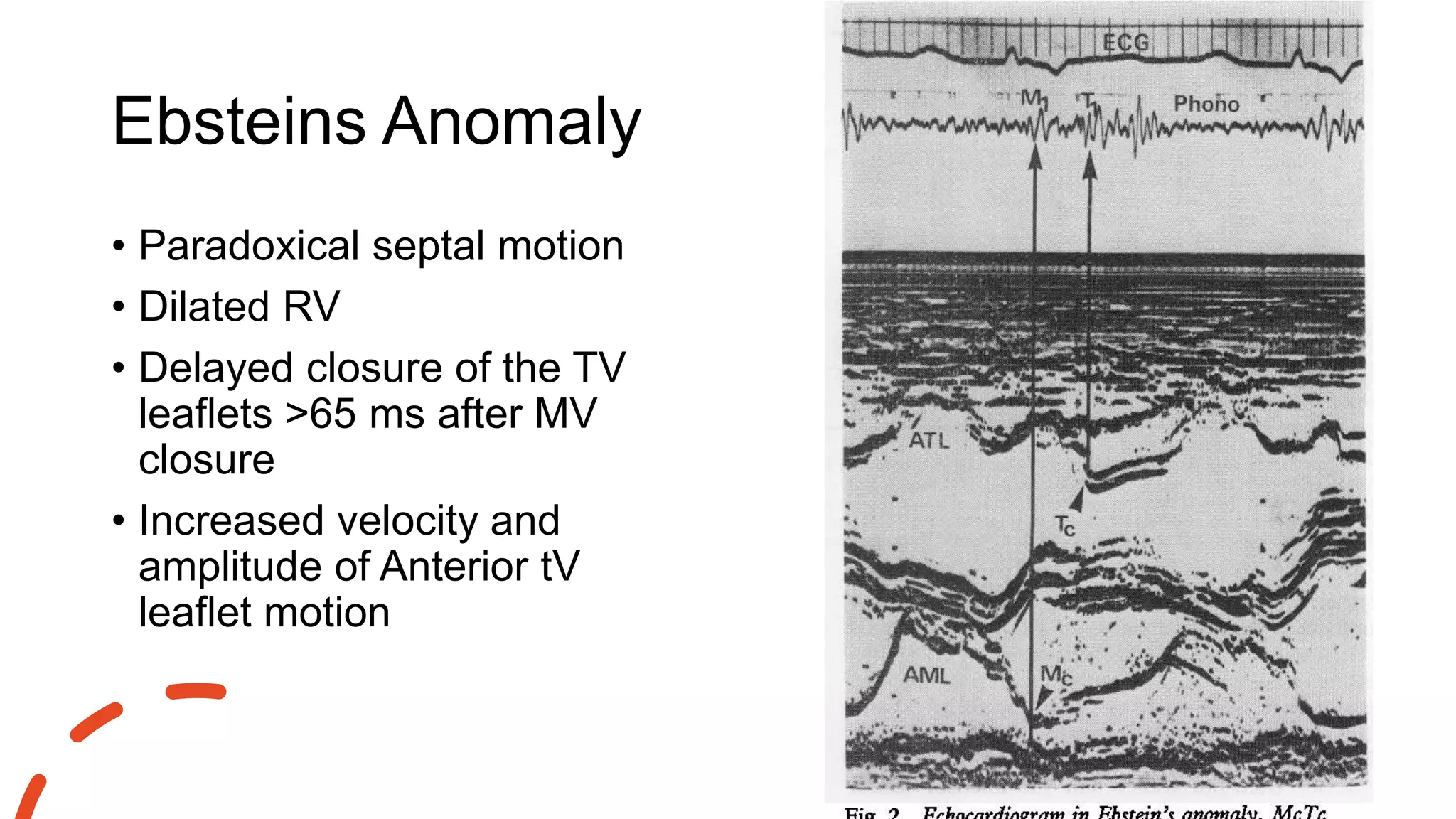 Ebsteins Anomaly
• Paradoxical septal motion
• Dilated RV
• Delayed closure of the TV
leaflets >65 ms after MV
closure
• Increased velocity and
amplitude of Anterior tV
leaflet motion
 