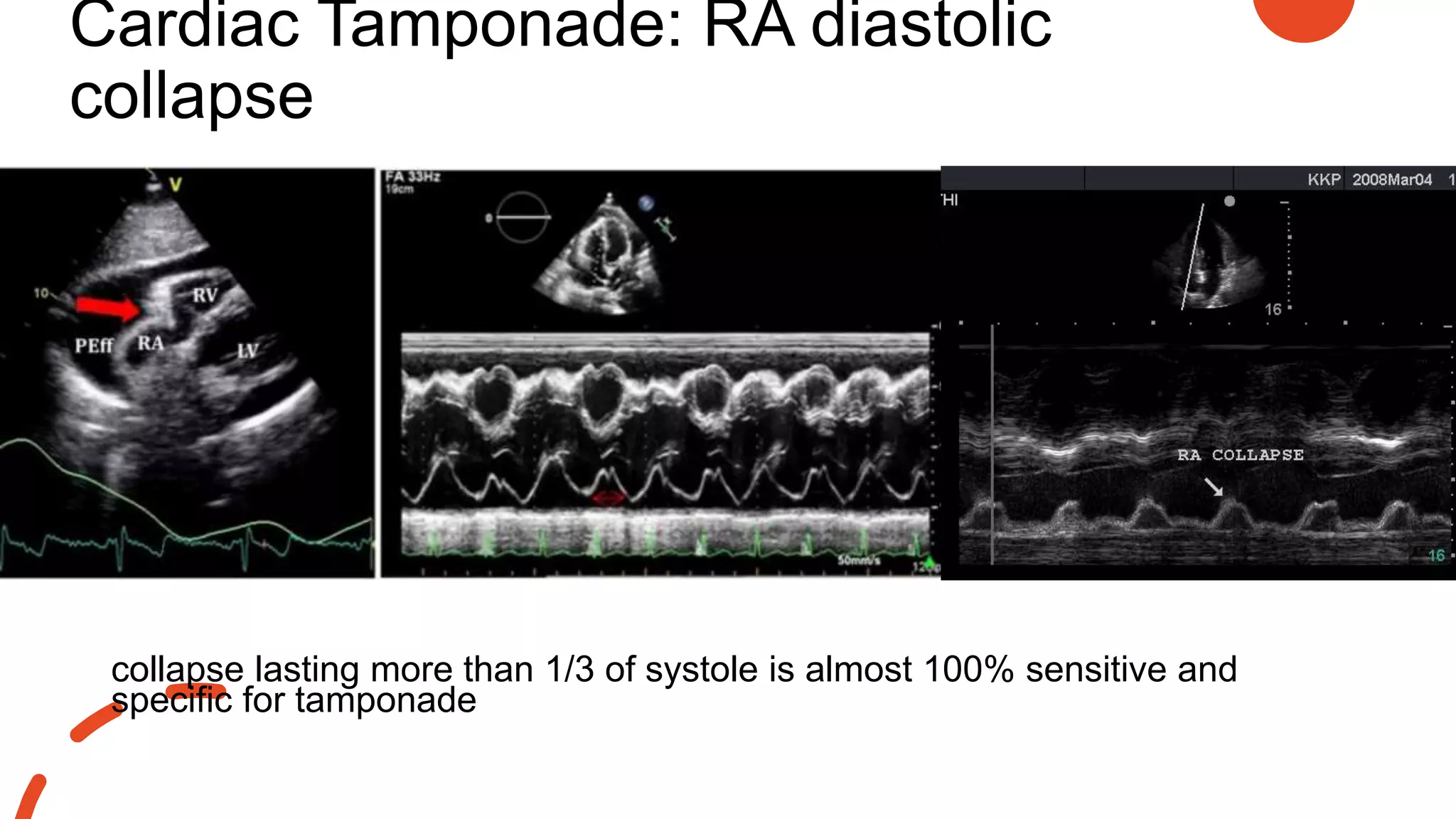 Cardiac Tamponade: RA diastolic
collapse
collapse lasting more than 1/3 of systole is almost 100% sensitive and
specific for tamponade
 