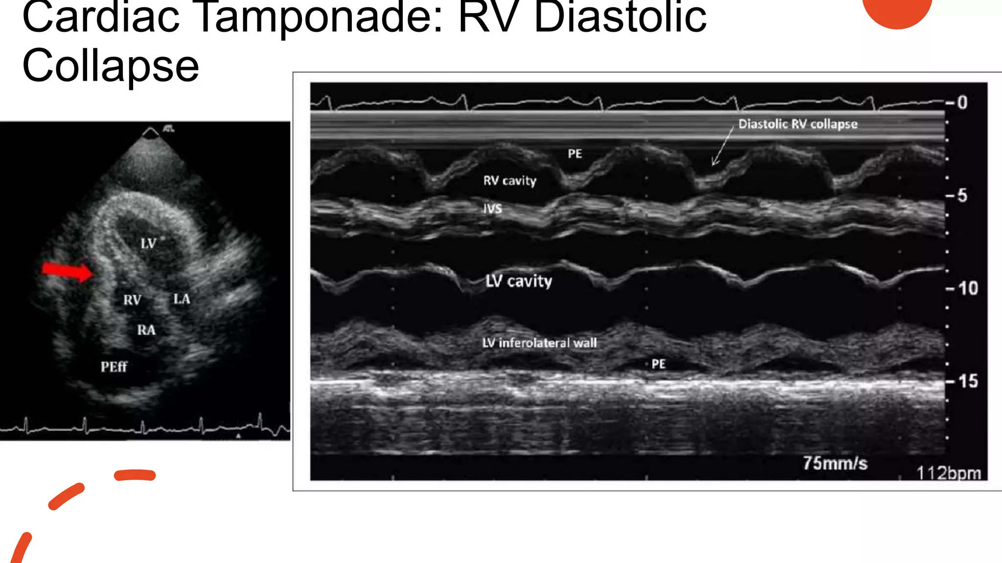 Cardiac Tamponade: RV Diastolic
Collapse
 