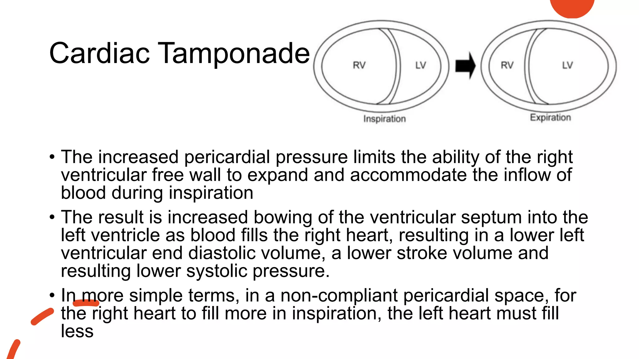 Cardiac Tamponade
• The increased pericardial pressure limits the ability of the right
ventricular free wall to expand and accommodate the inflow of
blood during inspiration
• The result is increased bowing of the ventricular septum into the
left ventricle as blood fills the right heart, resulting in a lower left
ventricular end diastolic volume, a lower stroke volume and
resulting lower systolic pressure.
• In more simple terms, in a non-compliant pericardial space, for
the right heart to fill more in inspiration, the left heart must fill
less
 