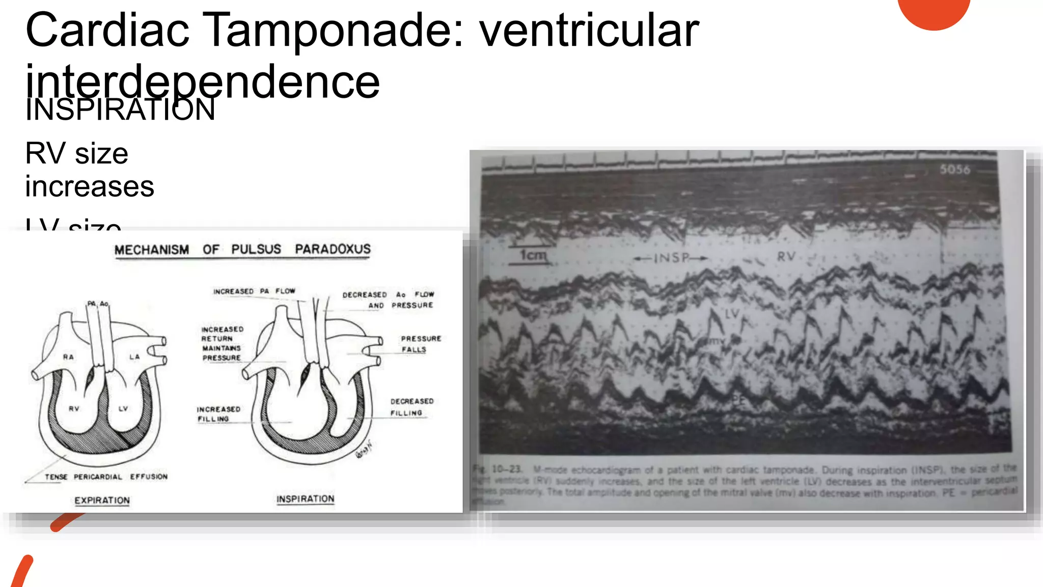 Cardiac Tamponade: ventricular
interdependence
INSPIRATION
RV size
increases
LV size
decreases
 