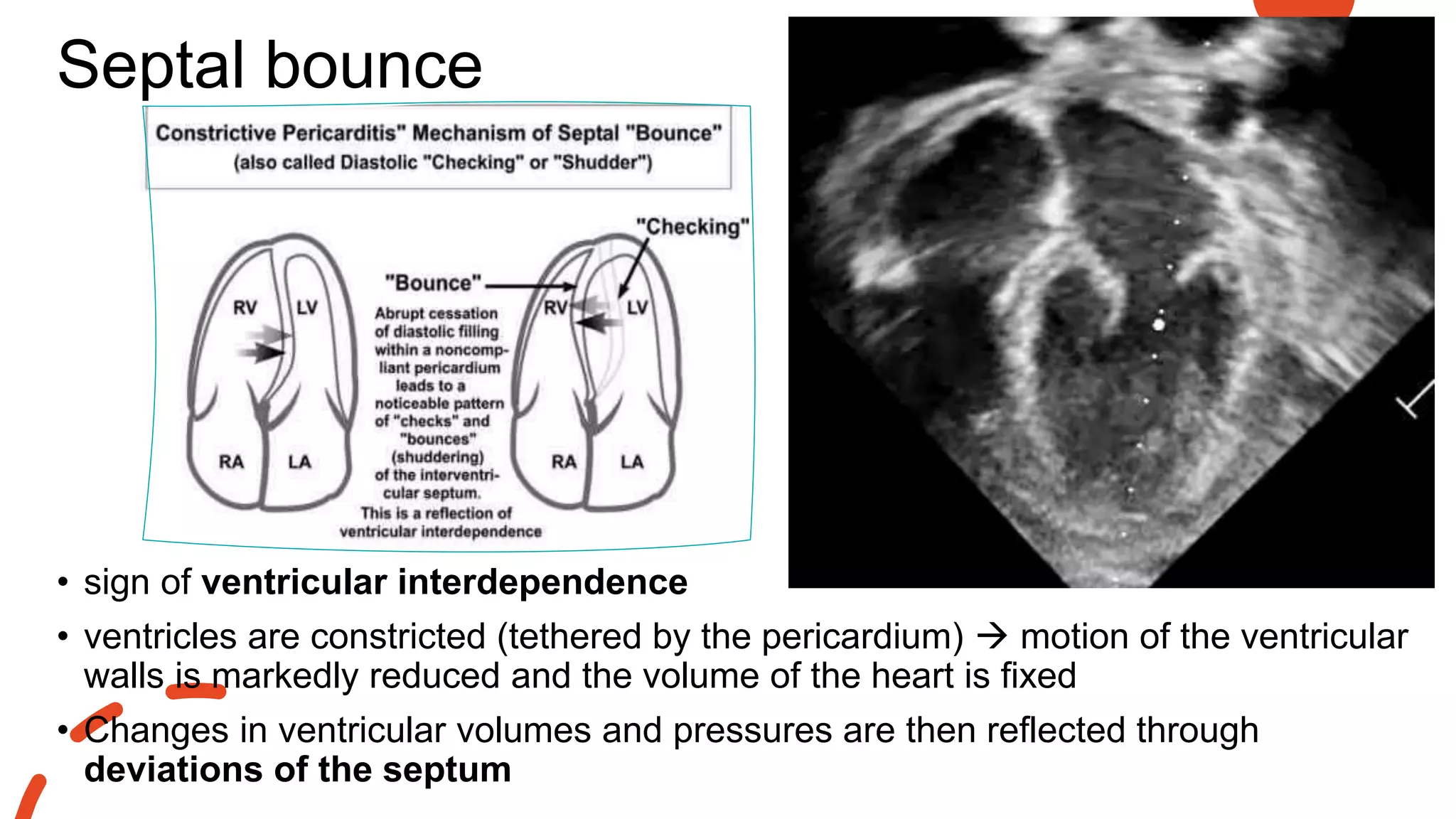 Septal bounce
• sign of ventricular interdependence
• ventricles are constricted (tethered by the pericardium)  motion of the ventricular
walls is markedly reduced and the volume of the heart is fixed
• Changes in ventricular volumes and pressures are then reflected through
deviations of the septum
 