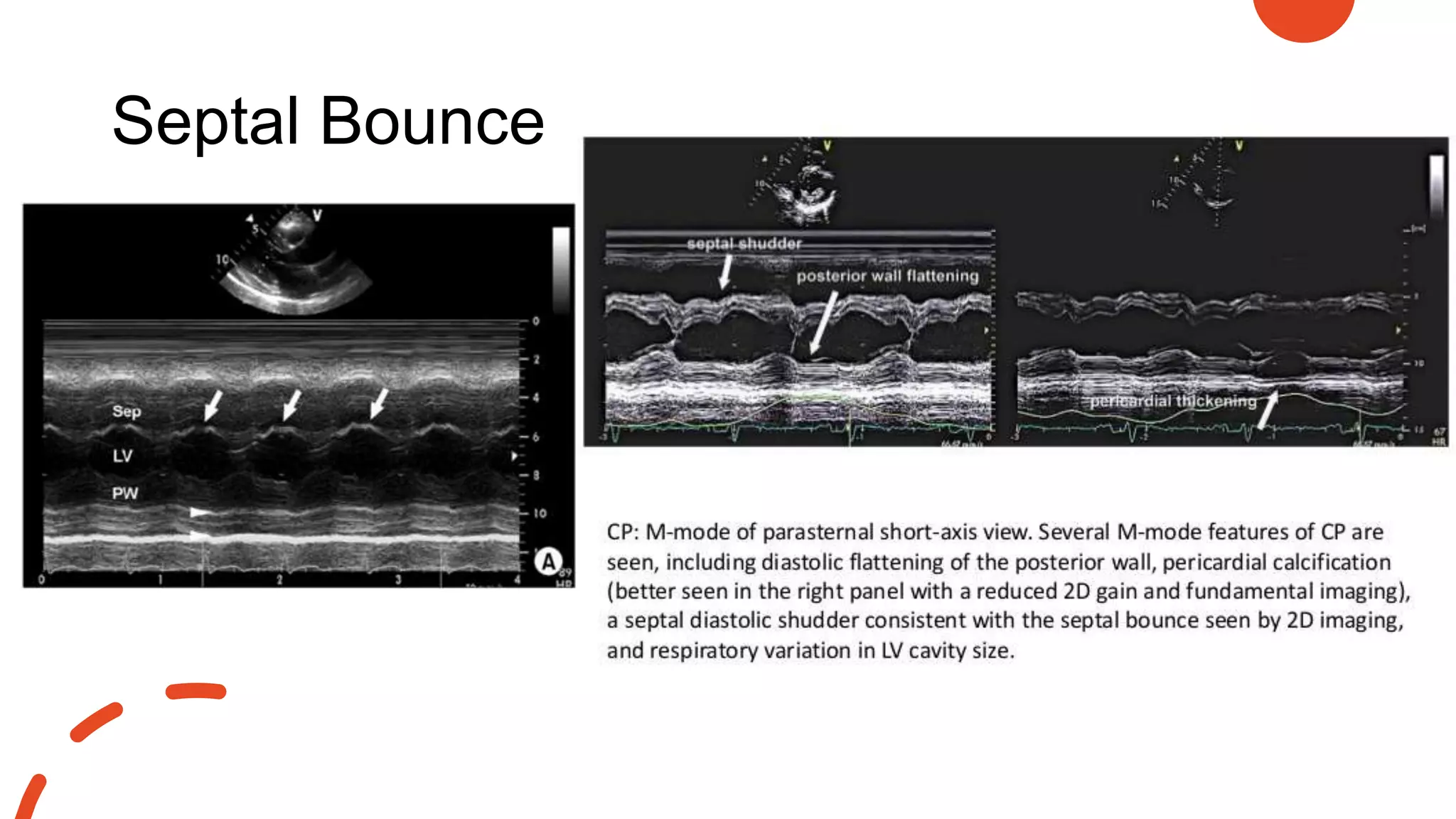 Septal Bounce
 