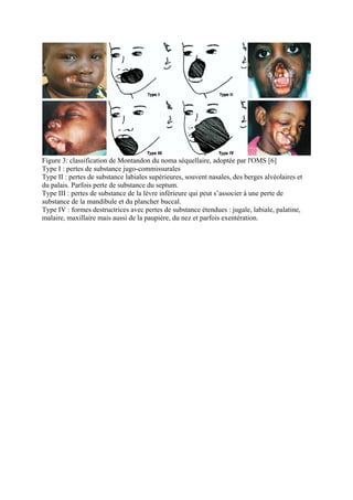 Figure 3: classification de Montandon du noma séquellaire, adoptée par l'OMS [6]
Type I : pertes de substance jugo-commissurales
Type II : pertes de substance labiales supérieures, souvent nasales, des berges alvéolaires et
du palais. Parfois perte de substance du septum.
Type III : pertes de substance de la lèvre inférieure qui peut s’associer à une perte de
substance de la mandibule et du plancher buccal.
Type IV : formes destructrices avec pertes de substance étendues : jugale, labiale, palatine,
malaire, maxillaire mais aussi de la paupière, du nez et parfois exentération.
 