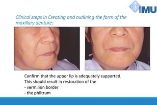 Clinical steps in Creating and outlining the form of the
maxillary denture:
Confirm that the upper lip is adequately supported.
This should result in restoration of the
- vermilion border
- the philtrum
 
